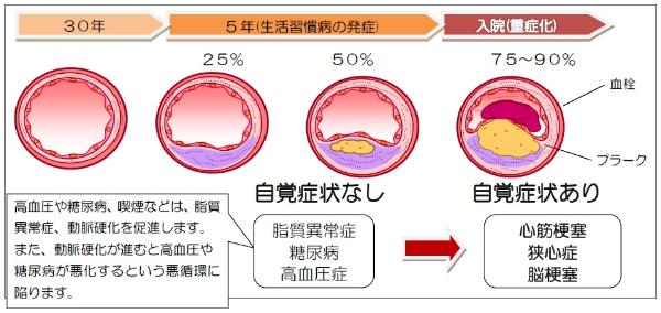 動脈硬化が進むと血管の中の画像